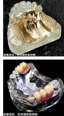金属床義歯