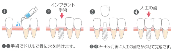 インプラント治療の流れ(固定式の場合)