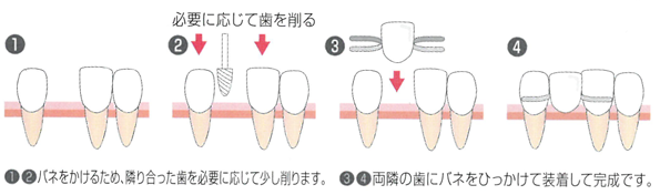 入れ歯治療の流れ