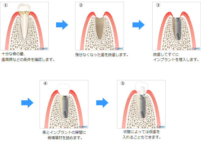 インプラント１回法