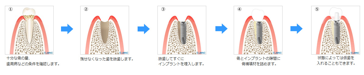 抜歯即時埋入即時荷重治療