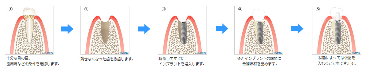 抜歯即時埋入即時荷重治療