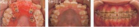 症例５：上顎の出っ歯