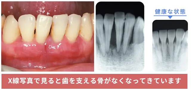 歯周病レントゲン