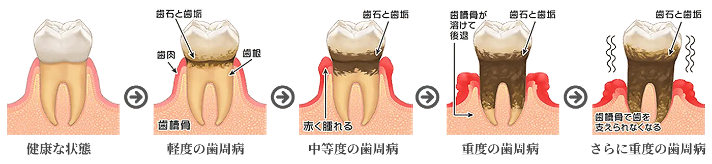 歯周病の進行