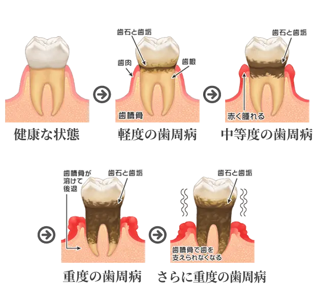歯周病の進行