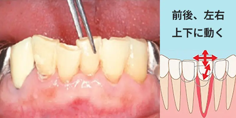 歯の動揺度検査
