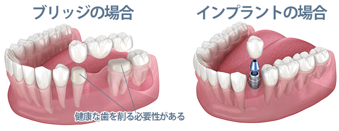 ブリッジと比較した場合