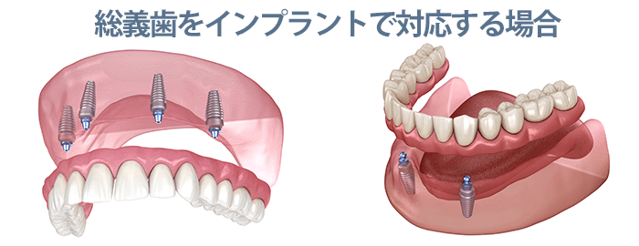 総義歯と比較した場合