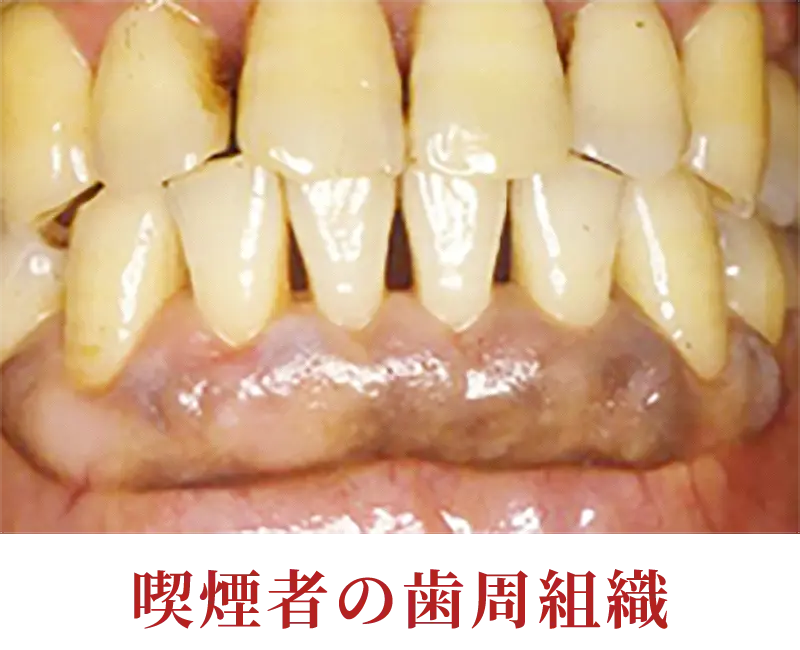 喫煙者